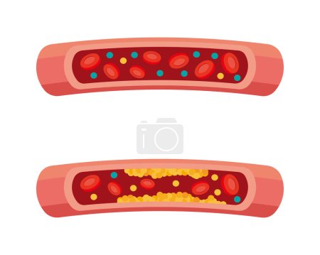 Imagen ilustrativa de colesterol y vasos sanguíneos