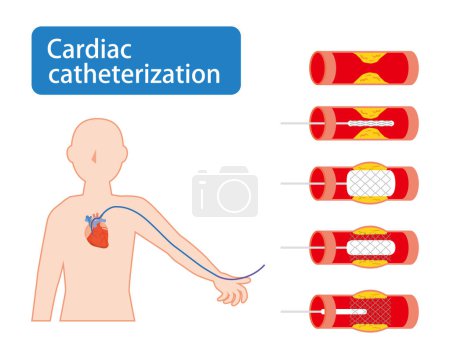 Illustration for Illustrated image of cardiac catheterization - Royalty Free Image