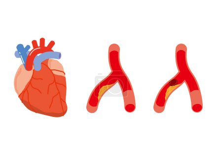 Illustration for Heart and narrowed blood vessels - Royalty Free Image