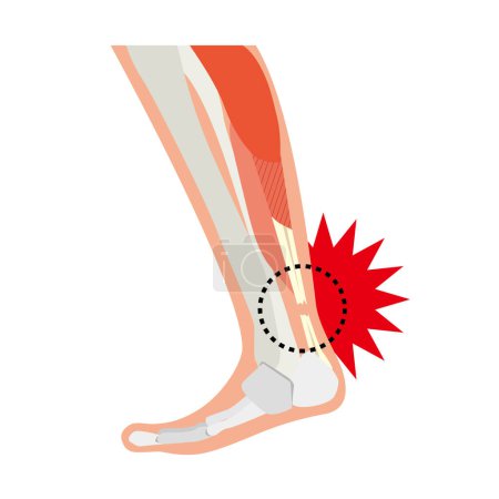 Illustration for Image illustration of a foot tearing the Achilles tendon - Royalty Free Image