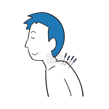 Ilustración de Un hombre recibiendo tratamiento de acupuntura en su hombro - Imagen libre de derechos