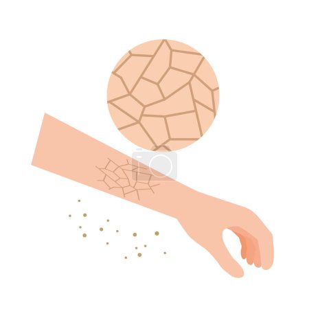 Illustration for Illustration of dry and cracked skin - Royalty Free Image