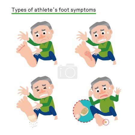 Ilustración de Un hombre que sufre de síntomas del pie de atleta - Imagen libre de derechos