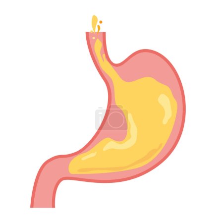 Illustration for Image illustration of reflux esophagitis - Royalty Free Image