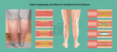 Photo for Diagram showing angioplasty for peripheral artery disease illustration. Concept of dry skin, old senior people, varicose veins and DVT . - Royalty Free Image