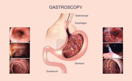 Photo for Digestive endoscopy or gastroscopy. Performing a gastroscopy procedure. Diagnostics of gastric diseases. Stomach health. Medical concept - Royalty Free Image