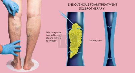 Endovenous laser treatment for varicose veins - foam sclerotherap concept. Before and after. Structure of vein