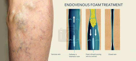 Photo for Endovenous laser treatment for varicose veins - foam sclerotherapy concept. Before and after. Structure of vein - Royalty Free Image