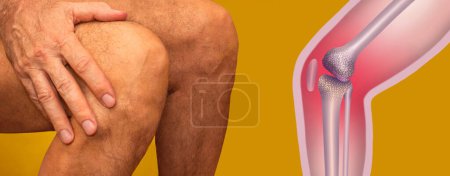 Foto de Anatomía humana. La estructura de la articulación de rodilla. Hombre mayor sosteniendo la rodilla con dolor. Collage.. - Imagen libre de derechos