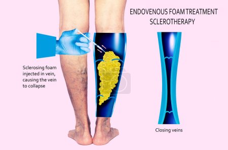 Endovenous laser treatment for varicose veins - foam sclerotherapy concept. Before and after. Structure of vein