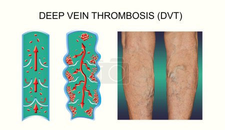 Photo for Deep Vein Thrombosis or Blood Clots. Embolus. Structure of normal and varicose female veins - Royalty Free Image