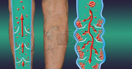 Deep Vein Thrombosis or Blood Clots. Embolus. Structure of normal and varicose female veins