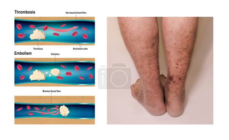 Photo for Deep Vein Thrombosis or Blood Clots. Embolus. Structure of normal and varicose male veins. Illustration was created by me - Royalty Free Image