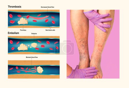 Deep Vein Thrombosis or Blood Clots. Embolus. Structure of normal and varicose male veins. Illustration was created by me