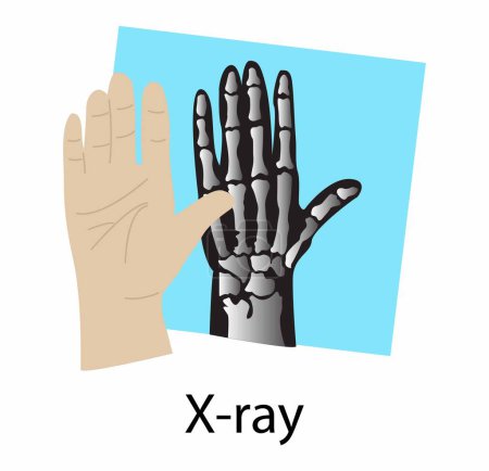 Illustration for Illustration of biology and physics, X ray image of human wrist and hand, X radiation is a penetrating form of high energy electromagnetic radiation - Royalty Free Image