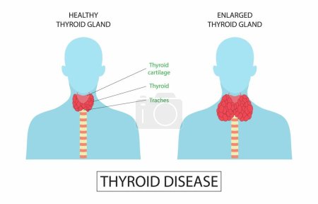 Téléchargez les illustrations : Illustration de la biologie et de la médecine, les troubles thyroïdiens peuvent aller d'un petit goitre inoffensif qui n'a pas besoin de traitement au cancer mortel, à la glande thyroïde saine et à la glande thyroïde élargie - en licence libre de droit