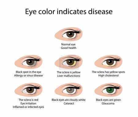 Ilustración de Illust de biología y médico, Color de ojos indica enfermedad, Signos de ojos malsanos, Color de ojos anormal indica salud o enfermedad, Infección ocular, Signos de salud - Imagen libre de derechos