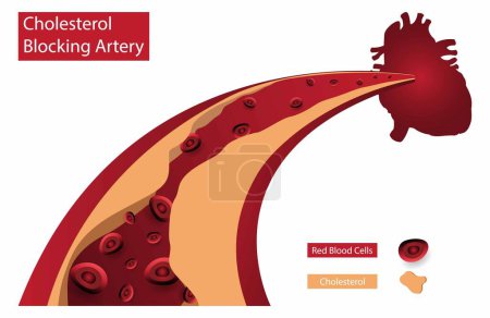 Illustration for Illustration of medical and hematology, Cholesterol Blocking Artery, Cholesterol and Artery Plaque Buildup, High blood pressure, fat, cholesterol and other substances build up in the walls of arteries - Royalty Free Image