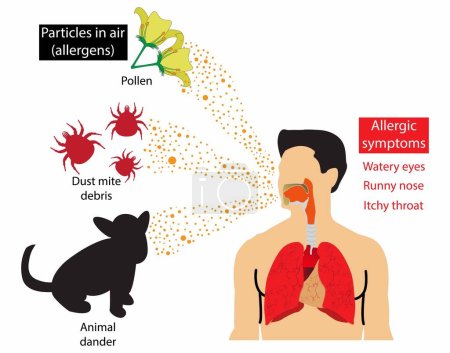 Téléchargez les illustrations : Illustration médicale et Pollution, Symptômes des allergies aéroportées, Particules dans les allergies à l'air, Les allergies sont causées par l'empoisonnement de l'air par le pollen et les acariens - en licence libre de droit
