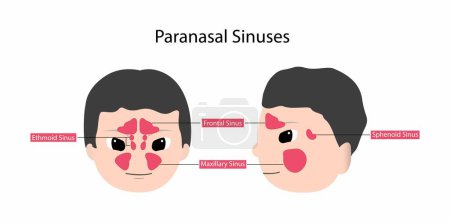 Illustration for Illustration of man with inflamed paranasal sinuses, Paranasal sinuses, Frontal, ethmoidal, sphenoidal and maxillary sinuses, Anterior and lateral view - Royalty Free Image