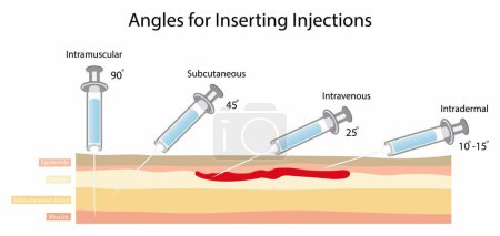 Illustration for Illustration of biology and medical, Angles for inserting injections, Simple drawing of cross section of skin with three needles administering injections at different angles, injection sites - Royalty Free Image