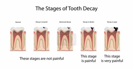Illustration for Illustration of biology and medical, The stages of tooth decay, Tooth decay is damage that occurs to teeth, Dental plaque is important to the tooth decay process - Royalty Free Image