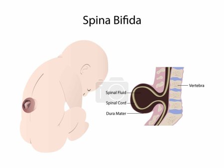 illust of biology and medical, Ilustración de un niño con espina bífida, Espina bífida es cuando la columna vertebral y la médula espinal de un bebé