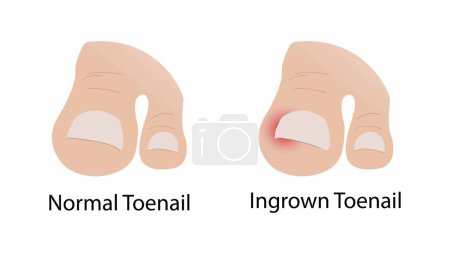 illustration of biology and medical, Normal Toenail and Ingrown Toenail, Ingrown toenails occur when the edges or corners of a nail grow into the skin