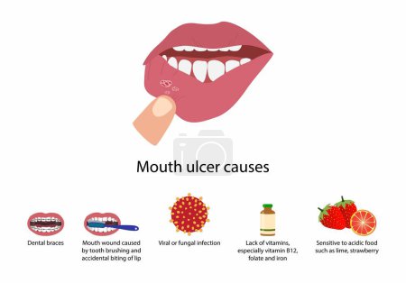 Illustration for Illustration of biology and medical, Aphthous ulcer, Mouth ulcer causes, Aphthous stomatitis, An ulcer in the mouth, caused by a break in the mucous membrane - Royalty Free Image