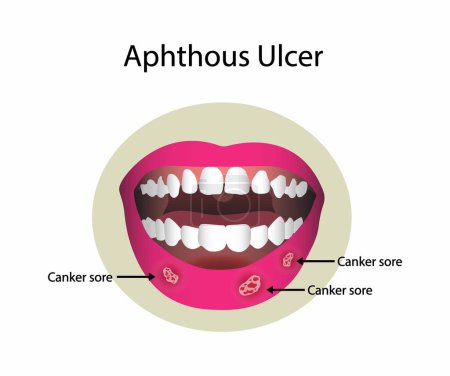 Illustration for Illustration of biology and medical, Aphthous ulcer, Mouth ulcer causes, Aphthous stomatitis, An ulcer in the mouth, caused by a break in the mucous membrane - Royalty Free Image