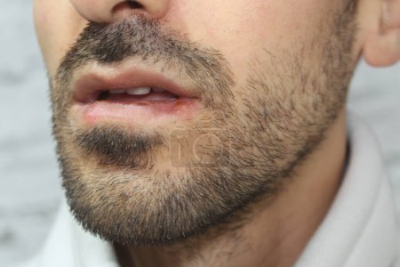 Foto de Infección por herpes en los labios de un hombre. Enfoque cercano y selectivo en la infección por herpes. - Imagen libre de derechos