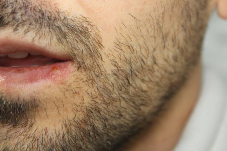 Foto de Infección por herpes en los labios de un hombre. Enfoque cercano y selectivo en la infección por herpes. - Imagen libre de derechos