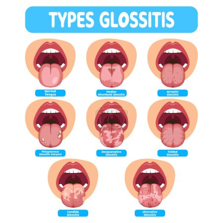 Foto de Ilustración de la enfermedad de infección oral glositis, ideal para infografías de medios, pancartas y folletos - Imagen libre de derechos