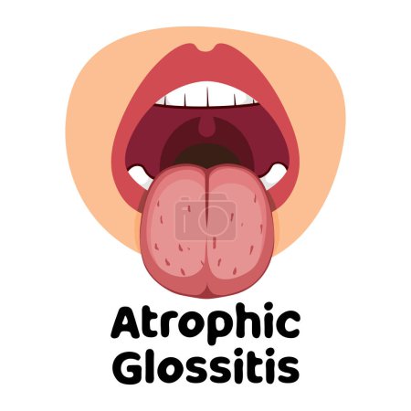 Illustration for Illustration of the oral infection disease glossitis, great for media infographics, banners and flyers - Royalty Free Image