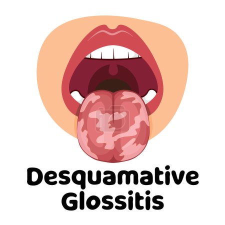 ilustración de la enfermedad de infección oral glositis, ideal para infografías de medios, pancartas y folletos