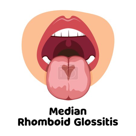 Illustration der oralen Infektionskrankheit Glossitis, ideal für Medieninfografiken, Banner und Flyer