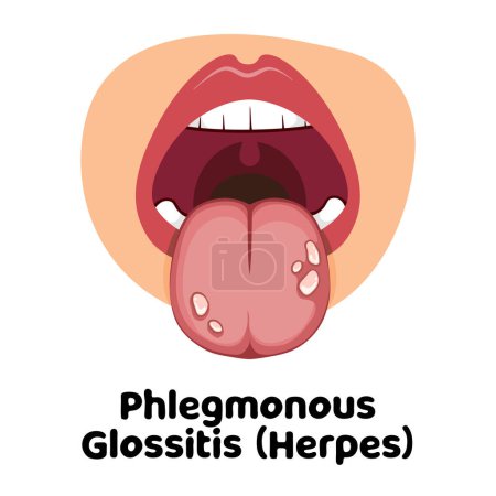 ilustración de la enfermedad de infección oral glositis, ideal para infografías de medios, pancartas y folletos