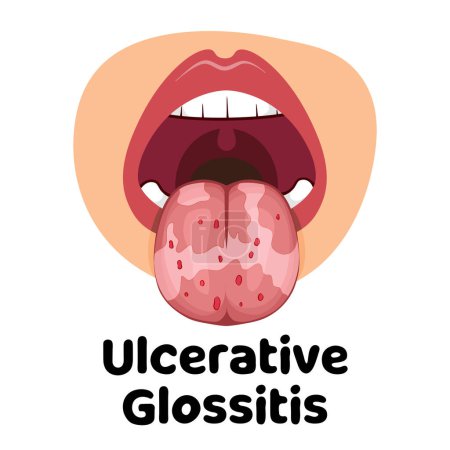 illustration of the oral infection disease glossitis, great for media infographics, banners and flyers