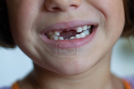 Fünfjähriges Mädchen zeigt Zähne, nachdem ihr vierter Zahn ausgefallen ist.