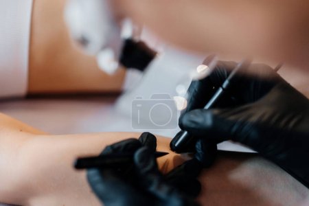 Photo for Close up view of doctor is doing electroepilation to the client, using electro needle and tweezers. Hair removal procedure, professional beauty care. Beautcians hands in gloves. High quality photo - Royalty Free Image