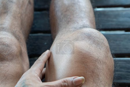 Téléchargez les photos : Entorse ligamentaire, luxation de la rotule, blessure due à un impact direct d'un objet dur pendant le sport sepak takraw, ce qui provoque douleur, ecchymoses et gonflement des tissus musculaires, Indonésie - en image libre de droit