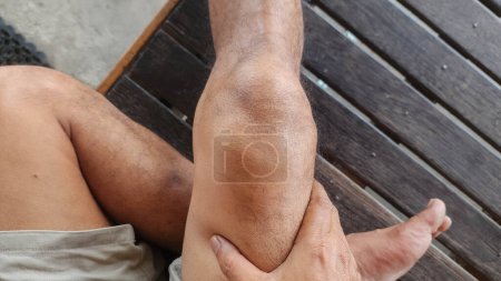 Foto de Esguince de ligamento, luxación de la rótula, lesión debida al impacto directo de un objeto duro durante el deporte takraw sepak, que causa dolor, hematomas e hinchazón del tejido muscular, Indonesia - Imagen libre de derechos
