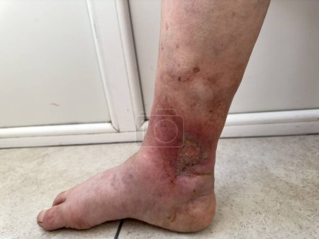 Deep large trophic ulcer on the lower leg, wound, skin and soft tissue defect. Complications of varicose veins of the leg, wetting trophic wound, eczema, dermatitis. serious diseases