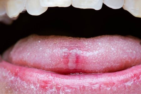 Photo for 4K Ultra HD Close-Up Image of Tongue with Canker Sores - Oral Health Awareness - Royalty Free Image