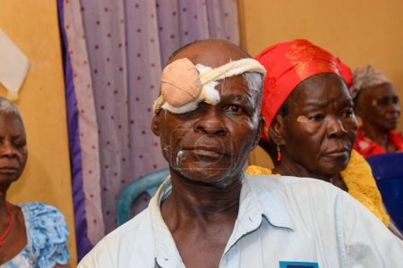 Téléchargez les photos : Abuja, Nigeria - 25 décembre 2021 : Homme africain d'âge moyen diagnostiqué de cataracte dans l'œil et préparé pour la chirurgie - en image libre de droit
