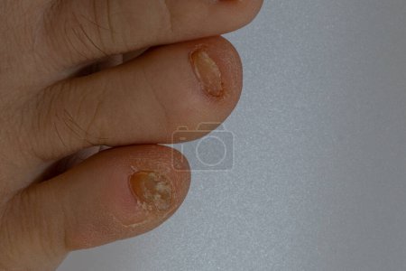 Photo for Fungal nail infection Onychomycosis. dry coarse skin of the legs eczema - Royalty Free Image