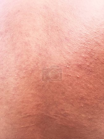 Foto de Erupción cutánea sensible o problema de la piel con erupción alérgica
. - Imagen libre de derechos