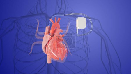 Téléchargez les photos : Concept médical d'implant pacemaker permanent - en image libre de droit