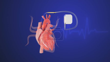 Téléchargez les photos : Battements de cœur artificiels dans un stimulateur cardiaque avec des lignes d'onde de battement de coeur - en image libre de droit
