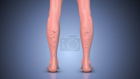 Photo for Varicose veins and leg diseases. - Royalty Free Image